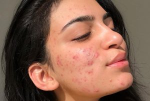 Mẹo Chăm Sóc Da Mụn Đầu Đen Da Dầu Lỗ Chân Lông To Tại Nhà