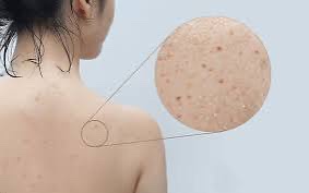 8 Mẹo Chăm Sóc Da Mụn Đầu Đen Ở Lưng Đúng Chuẩn, Giúp Bạn Tự Tin Hơn