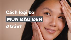 Mẹo Chăm Sóc Mụn Đầu Đen Ở Trán Cho Da Dầu Dễ Dàng.