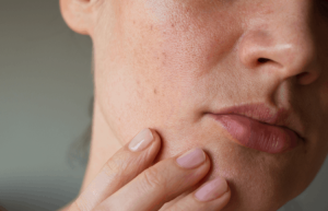  Bật Mí 7 Cách Chăm Sóc Mụn Cho Da Khô Vào Mùa Hè Tại Nhà Đơn Giản