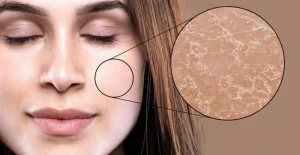 Chăm Sóc Da Mụn Mủ Da Khô Ở Cằm Đạt Hiệu Quả Cao