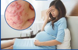 chăm sóc mụn cho da khô ở phụ nữ mang thai