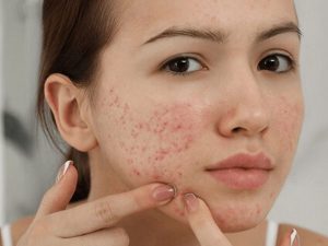  Bật mí 5 cách chăm sóc Mụn cho da khô bị dị ứng vô cùng hiệu quả và phục hồi nhanh chóng .