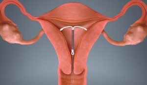 Dụng Cụ Tránh Thai Khẩn Cấp Vòng Tránh Thai Đồng Sau Khi Quan Hệ