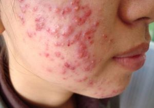 Mụn Mủ Ở Da Khô Hiệu Quả Chuẩn Y Khoa Không Để Lại Thâm Sẹo Sau 7 Ngày