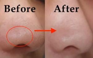 Bật mí cách chăm sóc mụn mủ da khô ở má hiệu quả nhanh vô