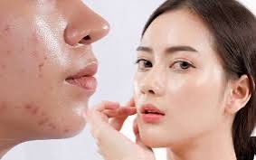 Bật Mí 10 Cách Chăm Sóc Mụn Trứng Cá Ở Da Khô Nhạy Cảm Tại Nhà