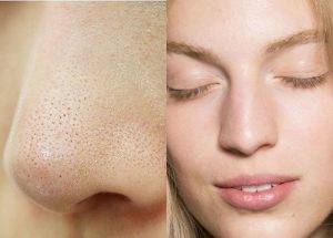 Mẹo Chăm Sóc Mụn Cám Cho Da Dầu Các Bạn Gái Nên Thử. 