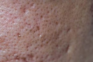 Chăm sóc da mụn lỗ chân lông to đúng cách chuẩn y khoa giúp bạn tự tin