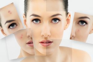 Bật Mí Điều Trị Mụn Ẩn Dưới Da Đơn Giãn Ít Tốn Kém Tại Nhà Sau 1 Tuần