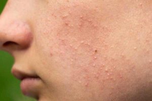 Điều Trị Mụn Ẩn Trên Da Mặt Đơn Giãn, Sạch Mụn, Hiệu Quả Tại Nhà 7 Nhà