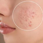 Điều Trị Mụn Đầu Trắng Và Bít Tắc Lỗ Chân Lông Tại Nhà Phục Hồi Nhanh Chóng