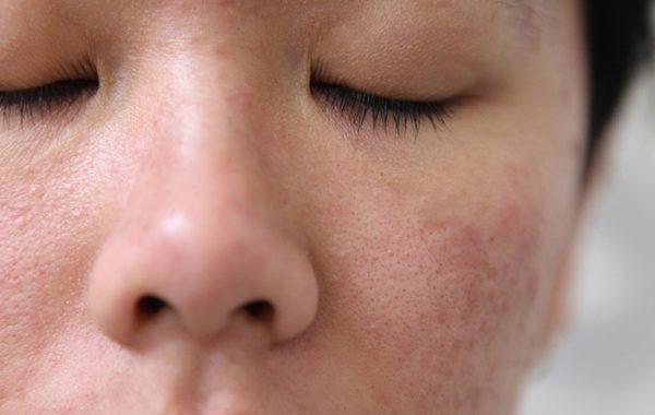 Cách Điều Trị Viêm Nang Lông Các Bạn Gái Nên Thử Sạch Viêm Sau 5 Ngày